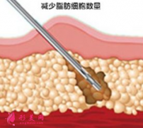 腰腹部吸脂需要多長時間消腫？