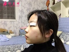 長沙梵童全切雙眼皮術(shù)后恢復(fù)情況反饋