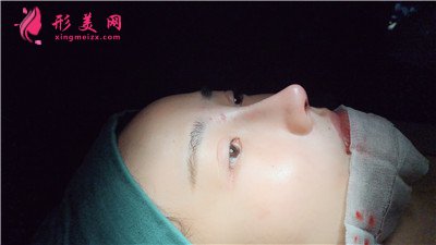 天津肋軟骨隆鼻術(shù)后恢復(fù)效果對比