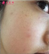 北京禾美嘉醫(yī)療美容水光針皮膚管理效果分享