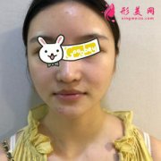熱瑪吉疼嗎？上海第九人民醫(yī)院熱瑪吉案例，提拉效果很贊