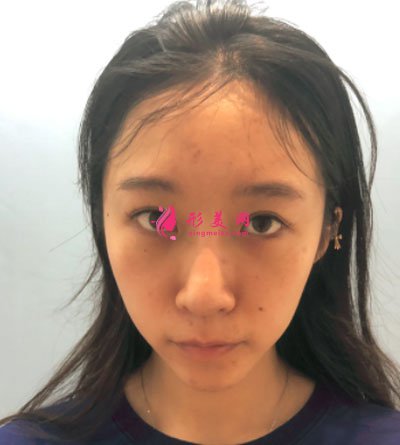 寧波薇琳醫(yī)療美容醫(yī)院眼部多項(xiàng)案例