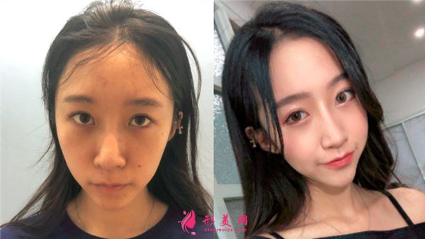 寧波薇琳醫(yī)療美容醫(yī)院眼部多項(xiàng)案例