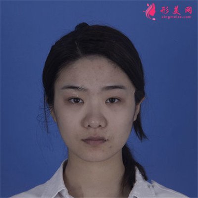 長(zhǎng)春耳軟骨隆鼻術(shù)后恢復(fù)效果展示