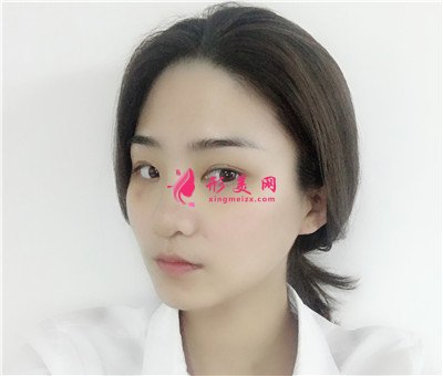 長(zhǎng)春耳軟骨隆鼻術(shù)后恢復(fù)效果展示 術(shù)后 長(zhǎng)春耳軟骨隆鼻術(shù)后恢復(fù)效果展示