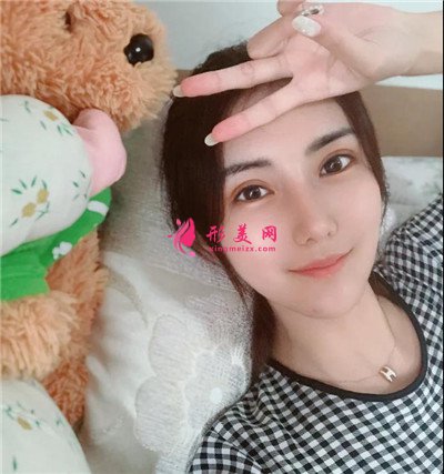 東莞切開雙眼皮術(shù)后恢復(fù)效果反饋