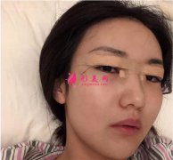 北京潤美玉之光醫(yī)療美容切開雙眼皮術(shù)后恢復(fù)效果反饋