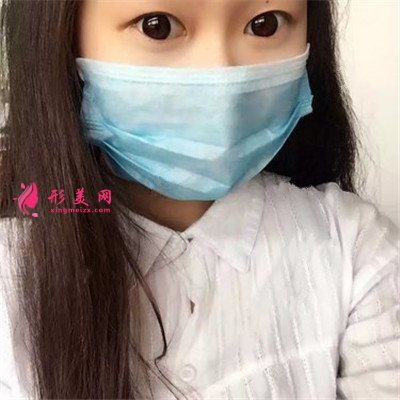 武漢眼部綜合案例反饋，這樣的雙眼皮我好喜歡~