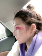 重慶軍美小仙女鼻綜合術(shù)后效果對比