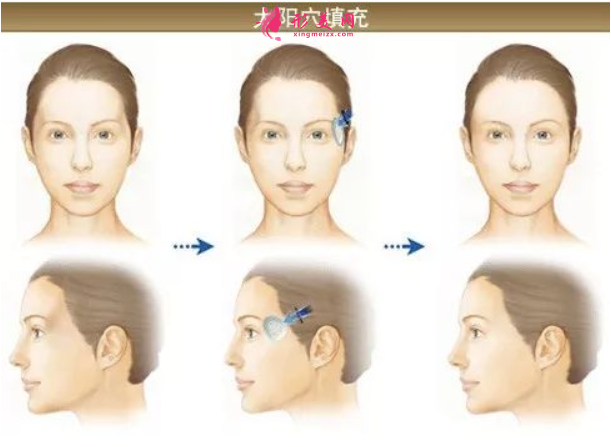脂肪填充臉部恢復(fù)期是多久