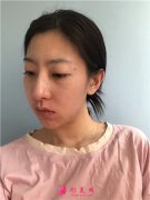 武漢藝星醫(yī)療美容醫(yī)院小姐姐的鼻部綜合手術(shù)術(shù)后效果分享