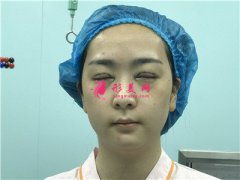 上海伯思立眼綜合術(shù)后恢復(fù)情況反饋