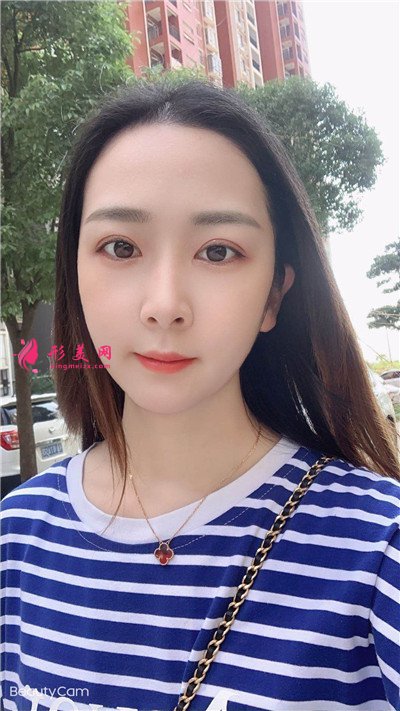 上海眼綜合術(shù)后恢復(fù)情況反饋