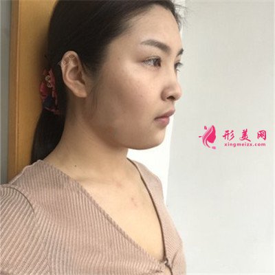 哈爾濱假體隆胸術(shù)后恢復(fù)情況對(duì)比