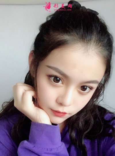 北京純脂自體做脂肪面部填充怎么樣？真實(shí)案例分