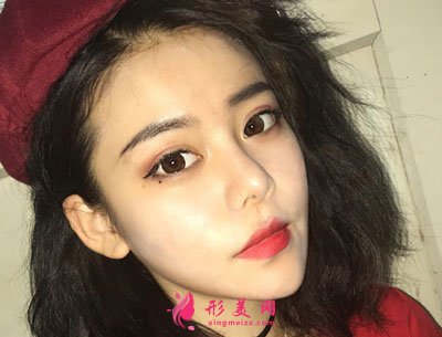 北京純脂自體做脂肪面部填充怎么樣？真實(shí)案例分