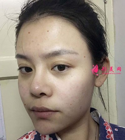 北京純脂自體做脂肪面部填充怎么樣？真實(shí)案例分