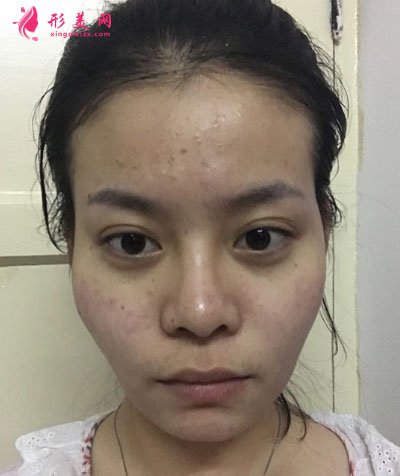 北京純脂自體做脂肪面部填充怎么樣？真實(shí)案例分