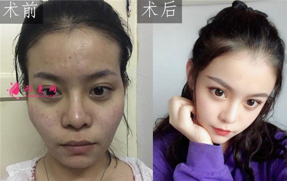 北京純脂自體做脂肪面部填充怎么樣？真實(shí)案例分