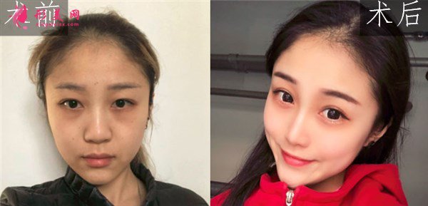 昆明美伊萊醫(yī)療美容鼻部多項案例