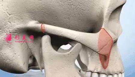 顴骨內(nèi)推手術(shù)后遺癥