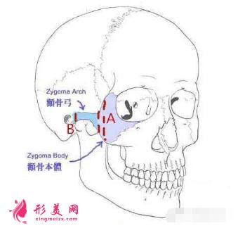 顴骨寬大:做一個(gè)顴弓內(nèi)推術(shù)治標(biāo)又治本!