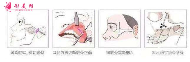 顴骨寬大:做一個(gè)顴弓內(nèi)推術(shù)治標(biāo)又治本