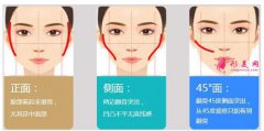 顴骨內(nèi)推手術(shù)的原理及術(shù)前術(shù)后注意事項！