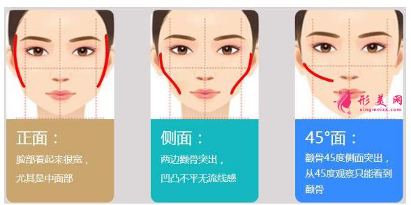 顴骨內(nèi)推手術(shù)的原理及術(shù)前術(shù)后注意事項！