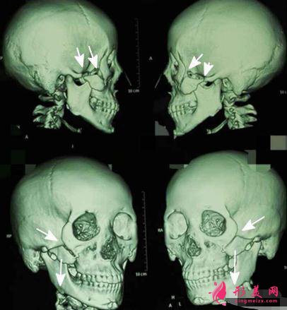 顴骨內(nèi)推手術(shù)的術(shù)前注意事項
