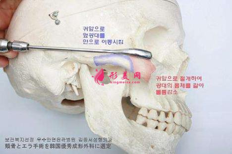 磨骨手術有7個步驟