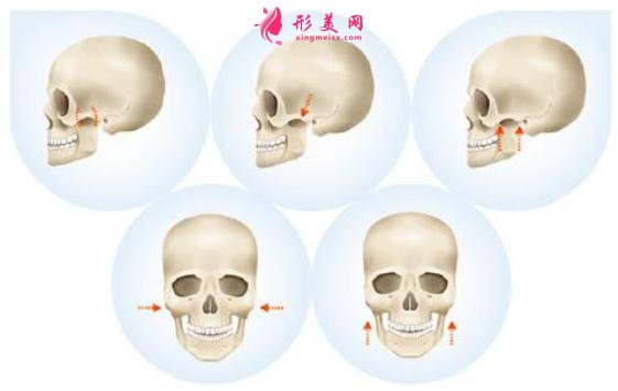 磨骨手術有7個步驟