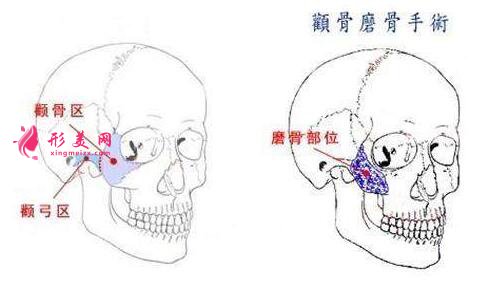磨顴骨