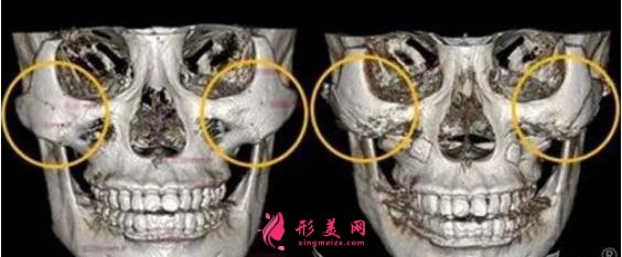 顴骨內(nèi)推的優(yōu)點