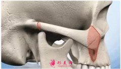 顴骨內(nèi)推的風險有哪些？有可能會出現(xiàn)這些并發(fā)癥！