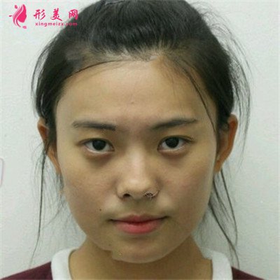 杭州全切雙眼皮術(shù)后恢復(fù)效果反饋