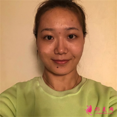 杭州小仙女的面部線雕術(shù)后效果分享