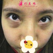 鄭州附二院激光去黑眼圈案例分享