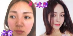 在成都圣丹福做的隆鼻怎么樣？來看看真實案例效果圖分享