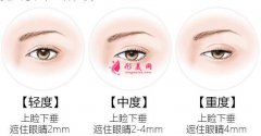 眉眼小拉皮有什么優(yōu)勢？