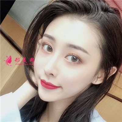 成都自體肋軟骨隆鼻術(shù)后恢復(fù)情況對比圖分享
