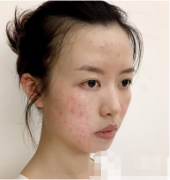 北京麗都醫(yī)療美容醫(yī)院價格表，附激光祛痘案例