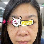 深圳鵬愛(ài)整形醫(yī)院激光去黃褐斑案例，皮膚無(wú)暇透亮