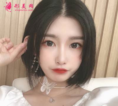 廣州星團整形醫(yī)院的全切雙眼皮案例