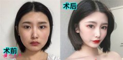廣州星團(tuán)整形醫(yī)院的全切雙眼皮怎么樣？案例對(duì)比