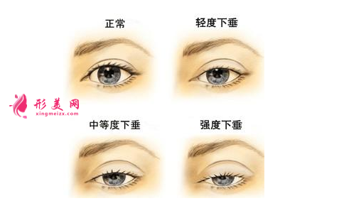 割雙眼皮整形醫(yī)院