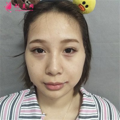 廣東自體脂肪面部填充術(shù)后效果對比