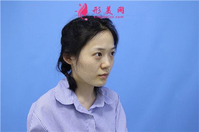 濟南鼻綜合術后恢復情況對比圖分享