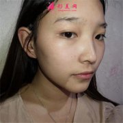 廣州可玉醫(yī)療美容門診部全切雙眼皮術(shù)后案例效果分享