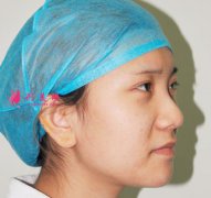 在北京煤炭總醫(yī)院做的鼻部多項(xiàng)怎么樣？來(lái)看看術(shù)后兩個(gè)月真人案例